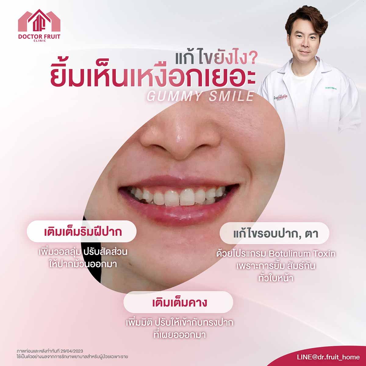 ยิ้มเห็นเหงือกเยอะ