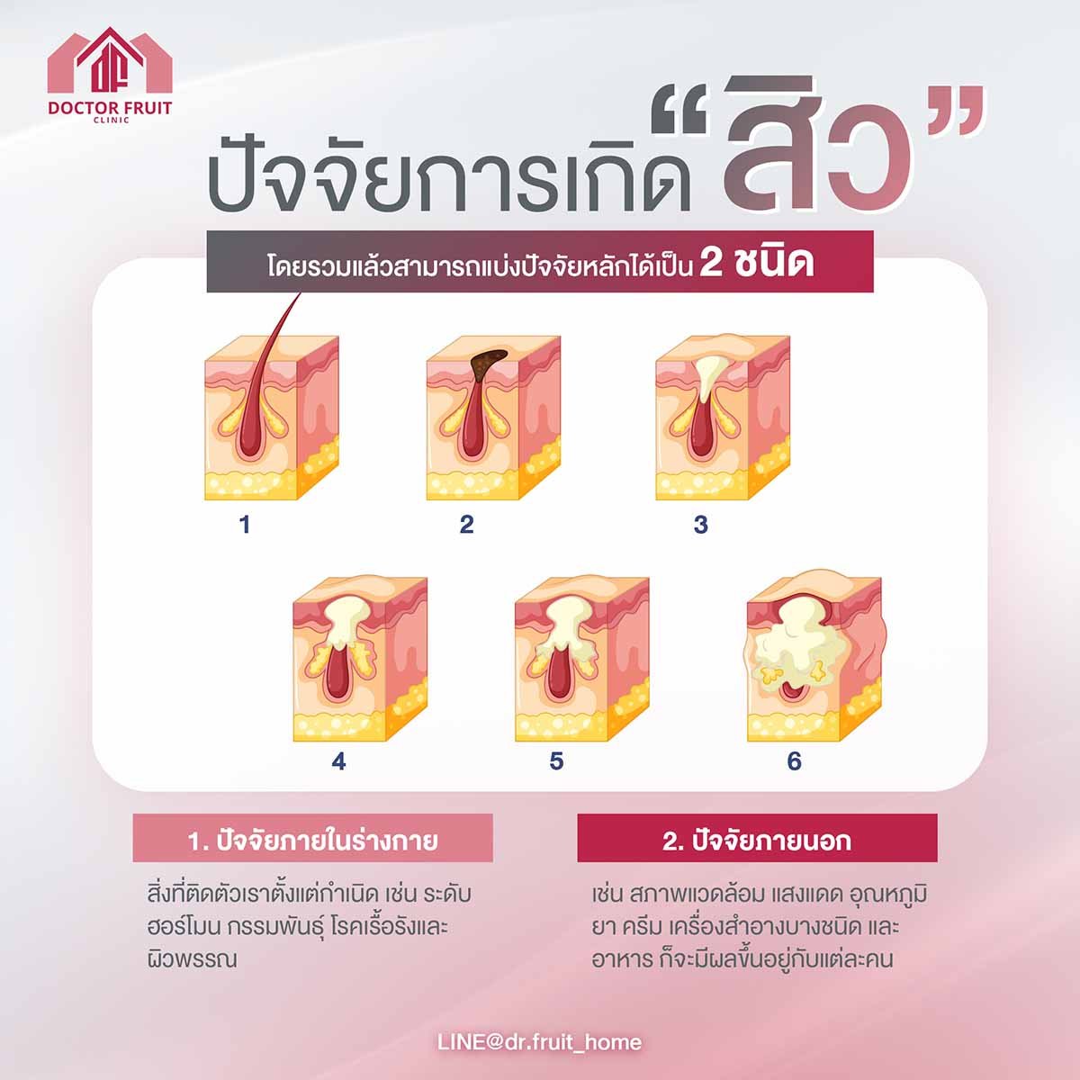 ปัจจัยของการเกิดสิว