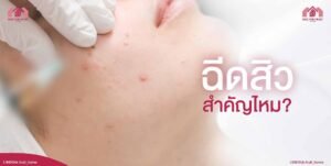 ฉีดสิว