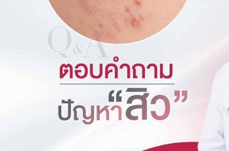 ตอบคำถาม ปัญหาสิว สาเหตุของการเกิดสิว และวิธีการรักษาสิว